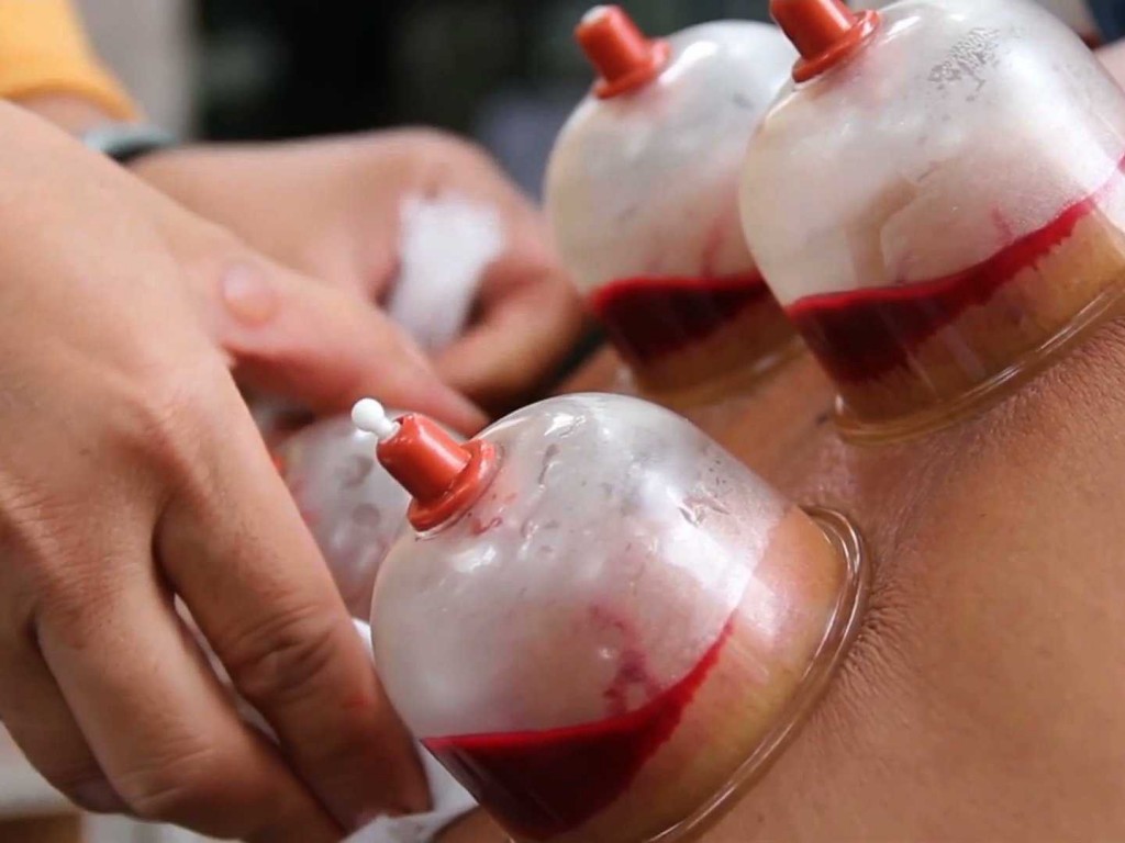 BloodCupping
